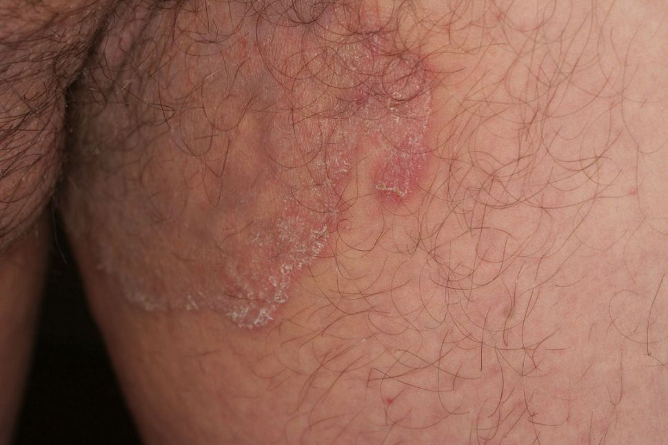 Tinea Inguinalis (Jock Itch)