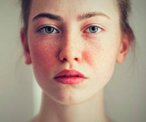 Rosacea (Gül Hastalığı)